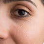 What Are These Tiny White Bumps on My Face?