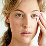 What to Do When You Have Blemishes and Dry Skin