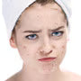 How to Treat Teen Blemishes